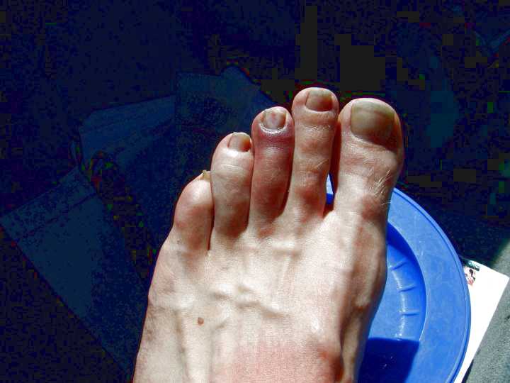 It doesn't look bad but it really hurt to walk, the whole toe was bruised and black.  Not a real concern as it is pretty much understood that I'm going to damage my feet the first night.